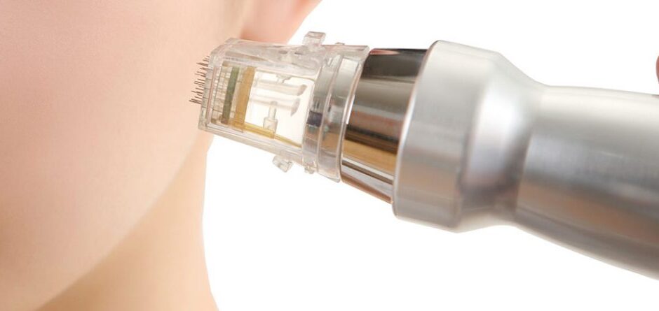 Altın İğne Yöntemi Nedir