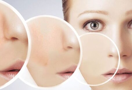 Thulium Lazer Leke Tedavisi